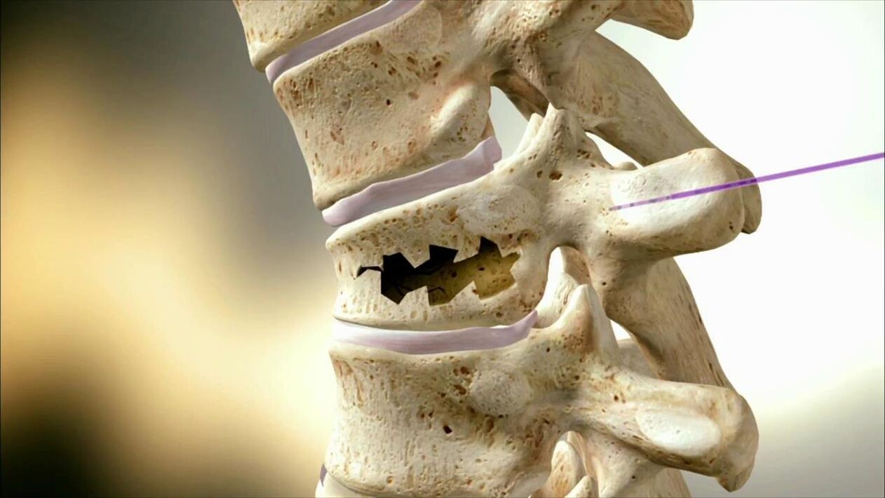 Columna vertebral danada