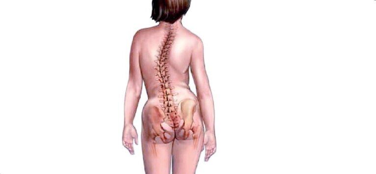 Osteocondrose