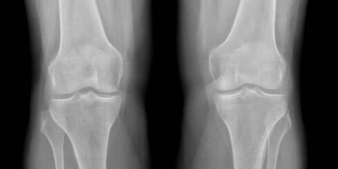 Artrose do xeonllo na radiografía