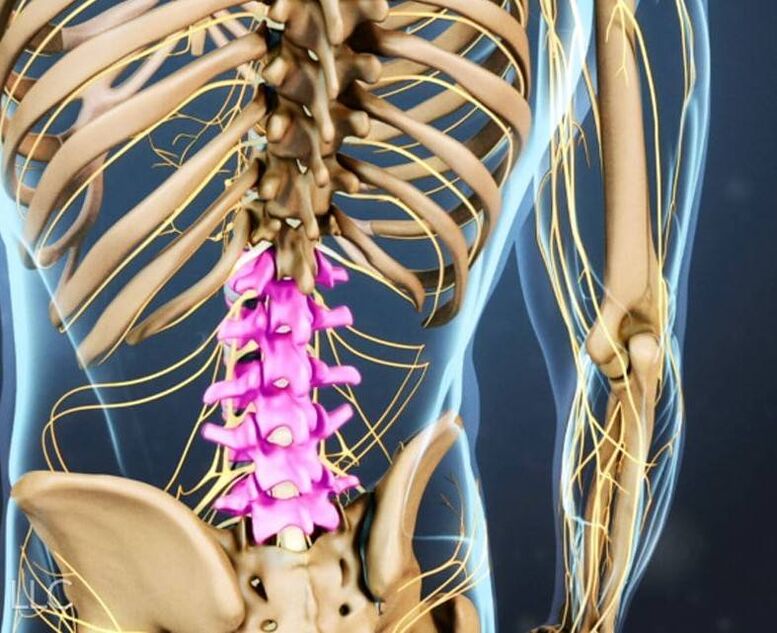 Osteocondrose da columna lumbar